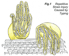 carpal1