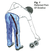 sciatica1