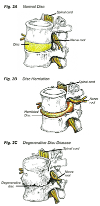 sciatica2