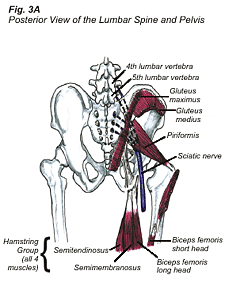 sciatica3a