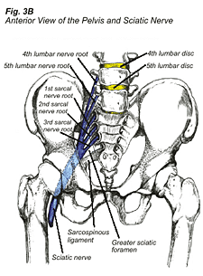 sciatica3b