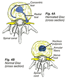 sciatica4